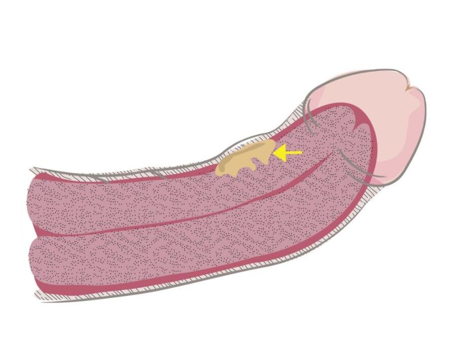 fibrous plaque on the penis